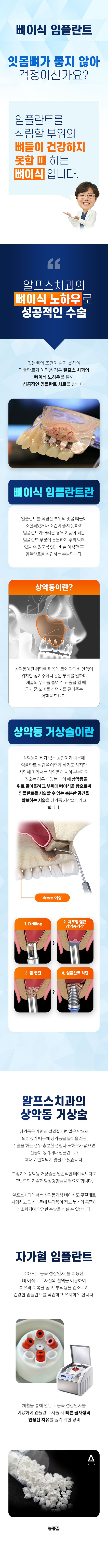 뼈이식 임플란트